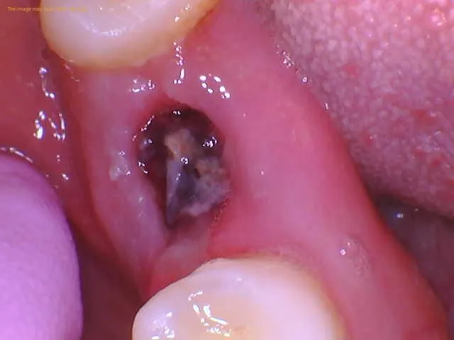 picture of dry socket formation after tooth extraction delaying the healing of socket and causing pain