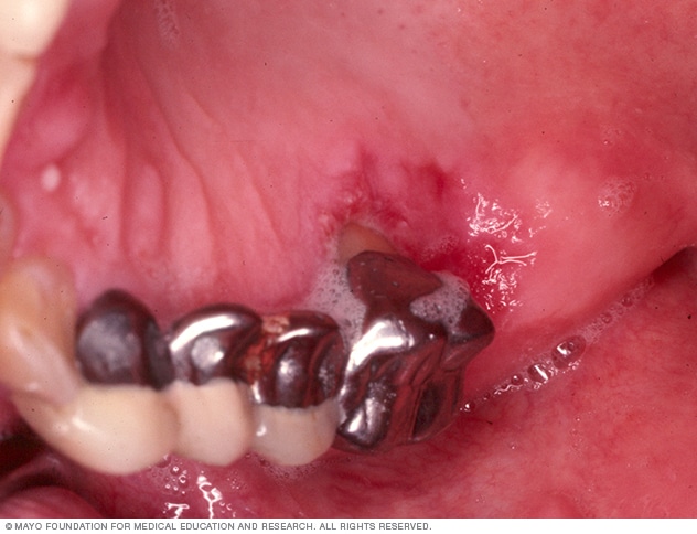 Mouth cancer picture