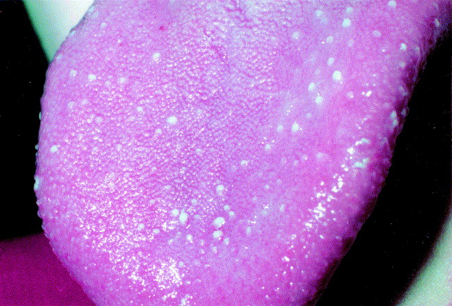 pimpl on tomgue Papulokeratotic Variant Transient lingual papillitis. bumps on tongue