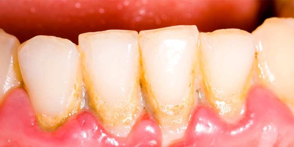 plaque on teeth, hard plaque on teeth. How to gt rid of hard plaque on teeth.