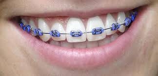 purple-braces-colored-braces-Best Braces Colors