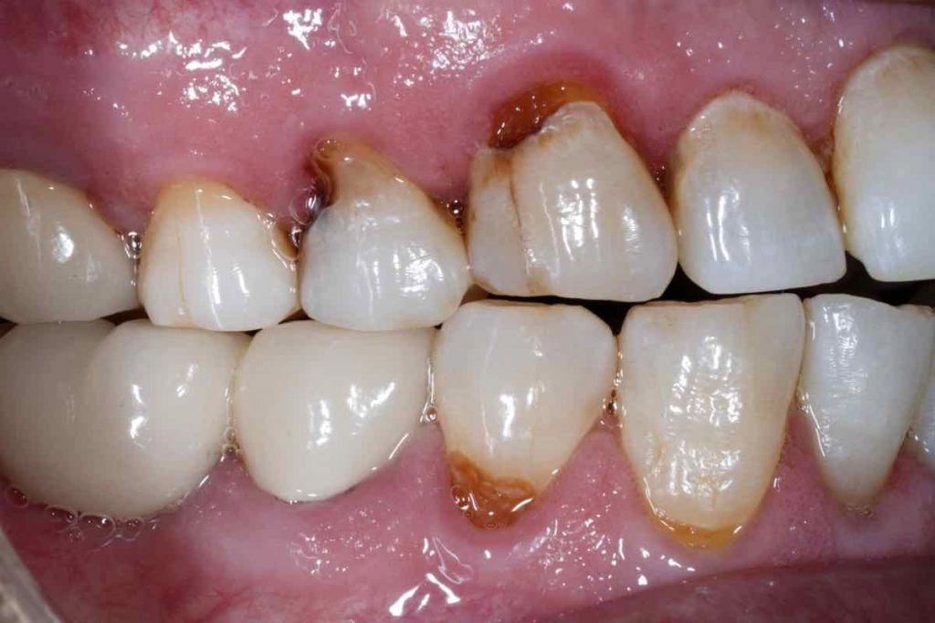 What Causes Rotten Teeth? Understanding the Main Culprits