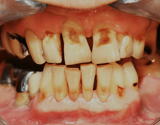 Signs and Symptoms of Rotten Teeth You Should Never Ignore