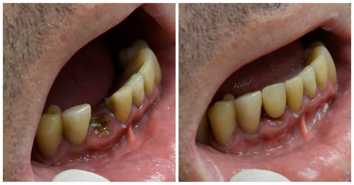 image showing same day teeth implants-dental implants in one day-teeth in-a-day