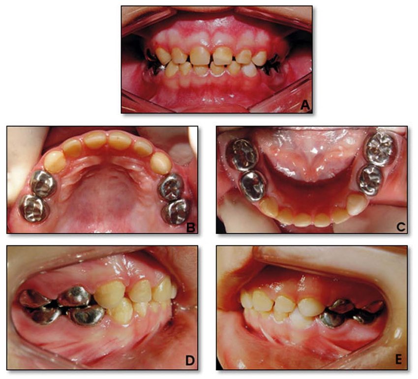 Silver teeth kids: A Frontal view of the completed treatment with stainless steel silver crowns and composite