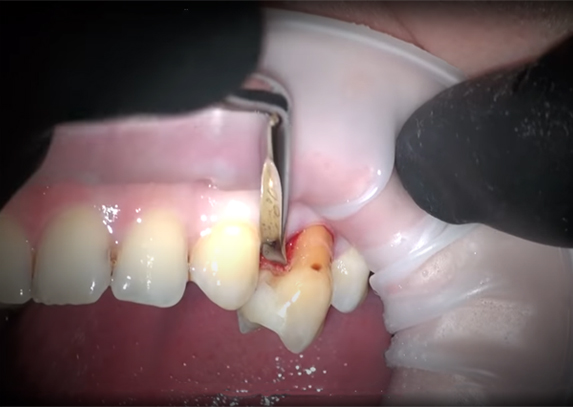 Simple tooth extraction. having tooth pulled without surgery