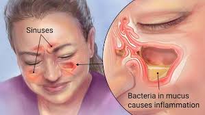 sinusitis-causing-Sore Throat and Ear Pain- Causes, Remedies, and How to Get Rid of Discomfort