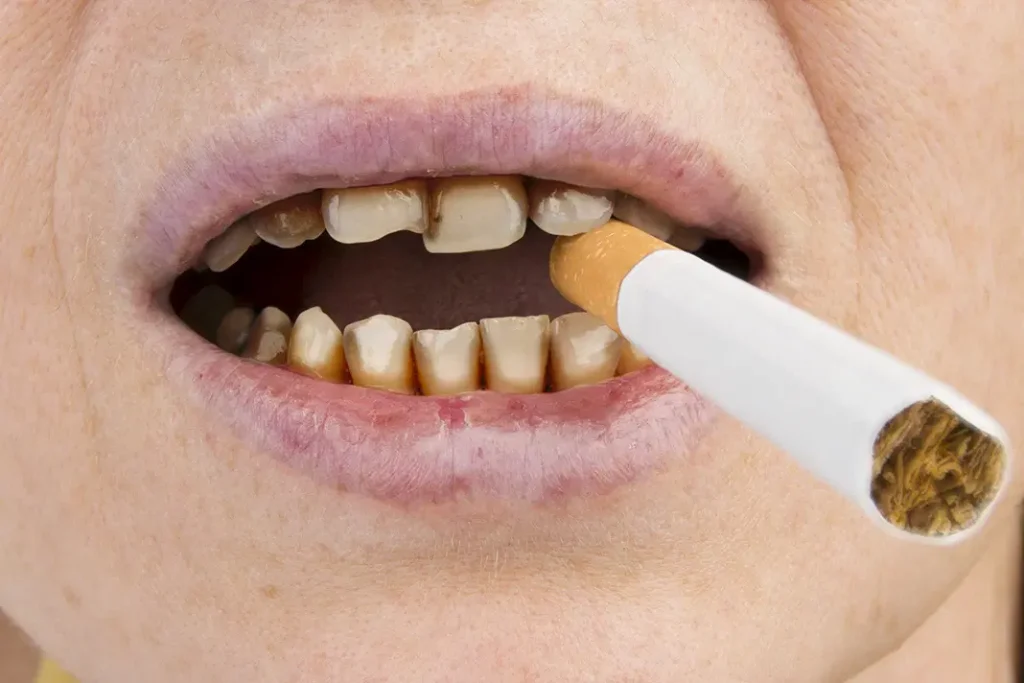 The Connection Between Rotten Teeth and Smoking