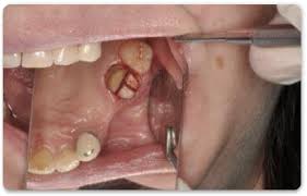 splitting the roots of tooth for pulling out