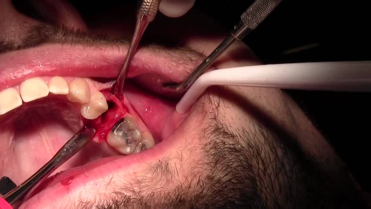 Surgical tooth extraction