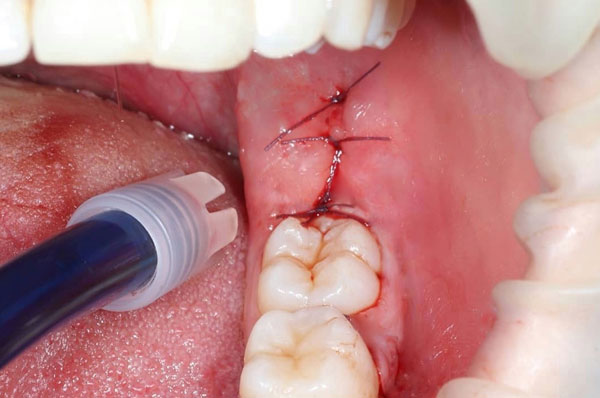 wisdom tooth removed sutures placed