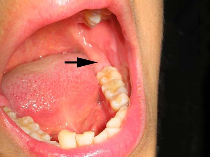 swollen gum behind back tooth no wisdom teeth, gum pain in back of mouth not wisdom teeth.