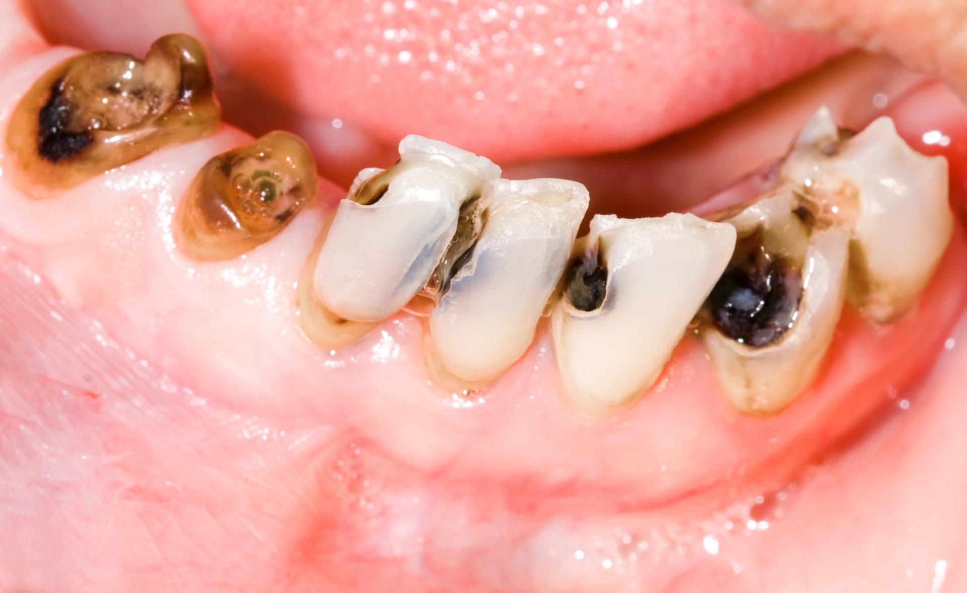 tooth decay and cavities in teeth at various stages.Tooth decay cavity in pits and fissure of tooth .What Does a Cavity Look Like? 