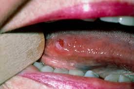 Tongue cancer picture