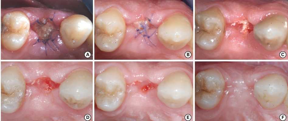 Tooth extraction healing at different stages during recovery