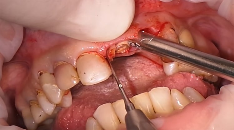 tooth extraction of broken root