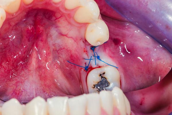 Tooth pulled out and sutures placed to prevent dry socket formation