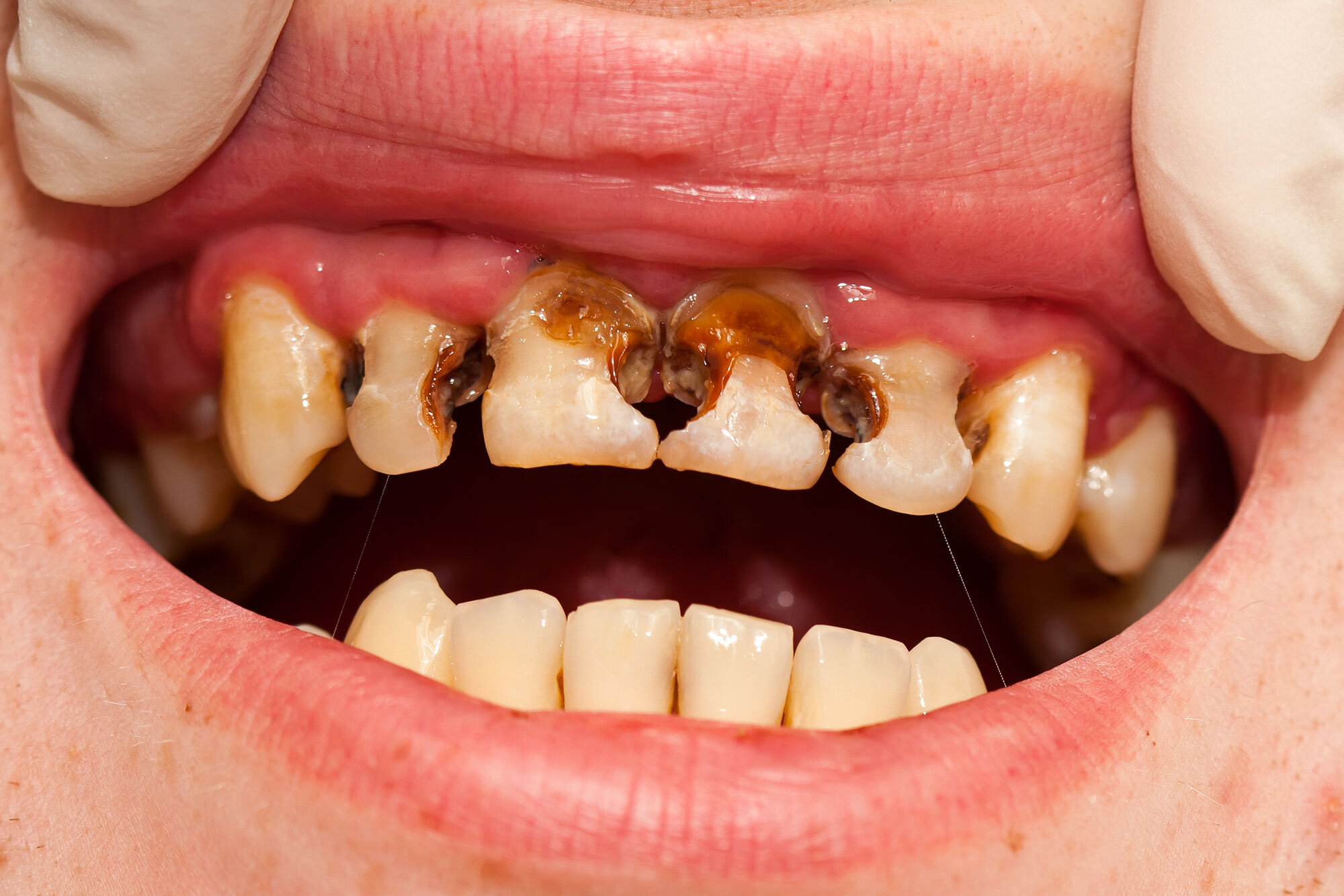 Rotten Teeth: Causes, Symptoms, Treatment, and Prevention