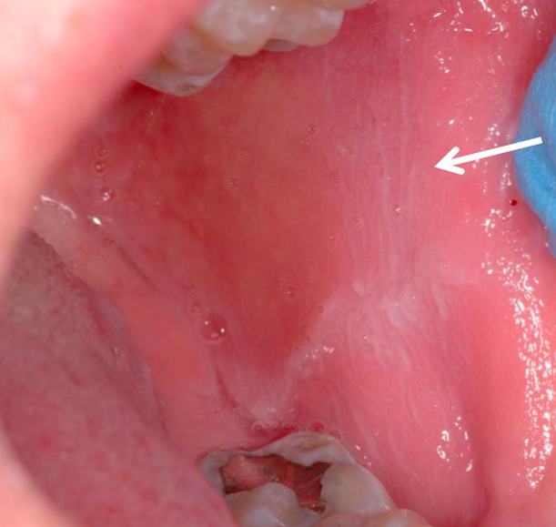 Why Do I Keep Biting My Cheek? Causes, Prevention, and Solutions