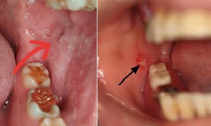 Cheek biting scar formed due to biting inside of mouth while eating. why do i keep biting the inside of my cheek