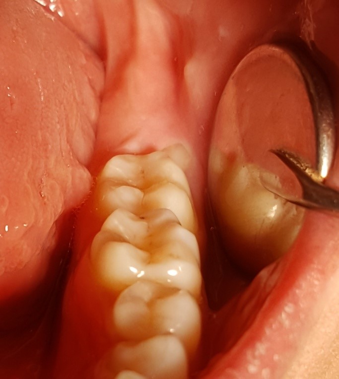 wisdom teeth hurt badly during coming in due to infection in gums area