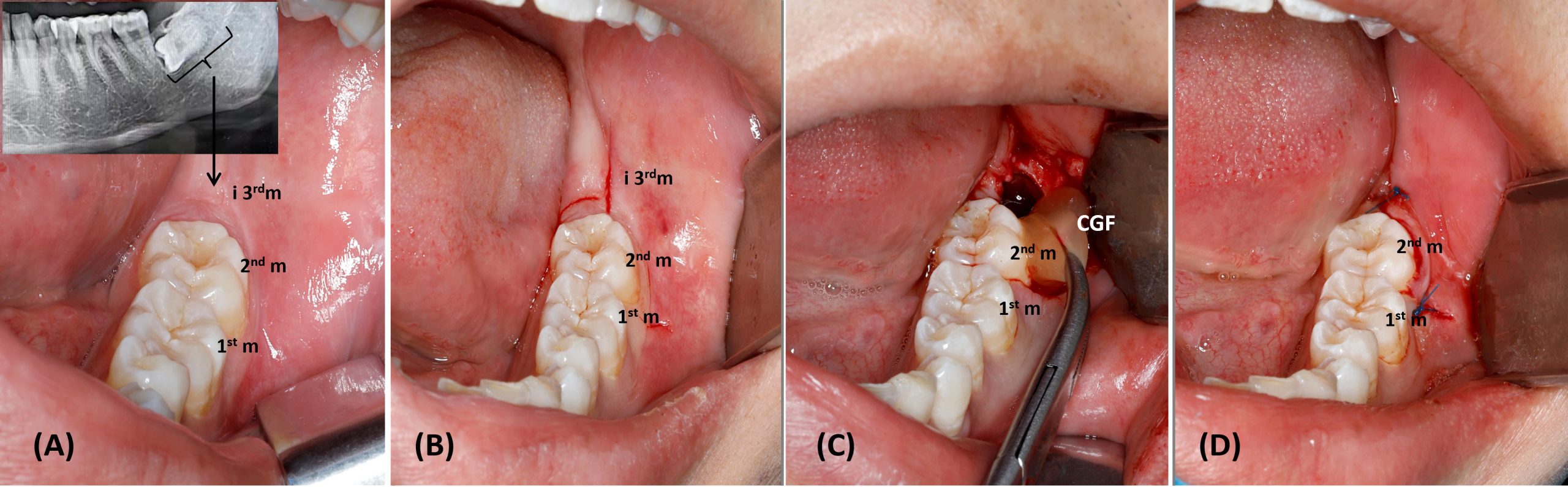 wisdom tooth removal process and wound healing