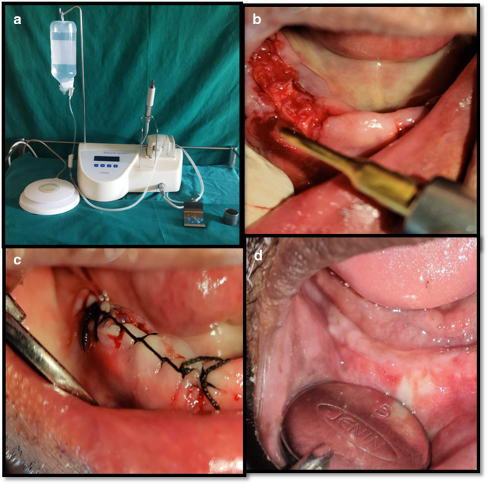 Alveoloplasty Procedure For Denture Placement With Piezosurgery Technique