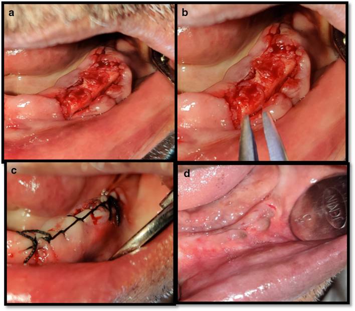 alveoloplasty for dentures. Alveoloplasty Procedure For Denture Placement