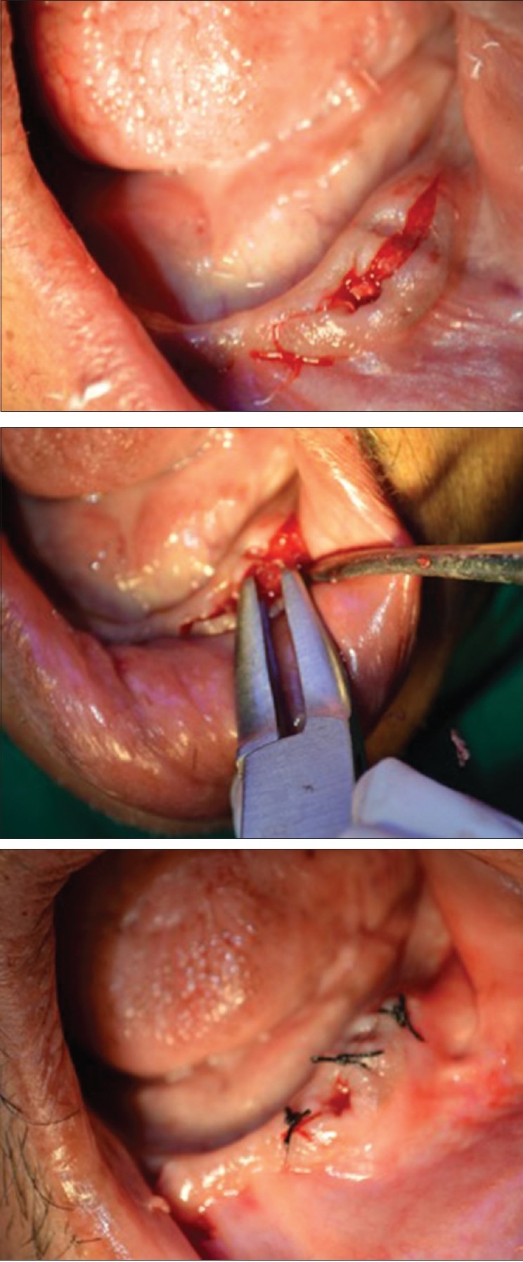 Alveoloplasty Procedure Of Lower Jaw Shaping For Denture.