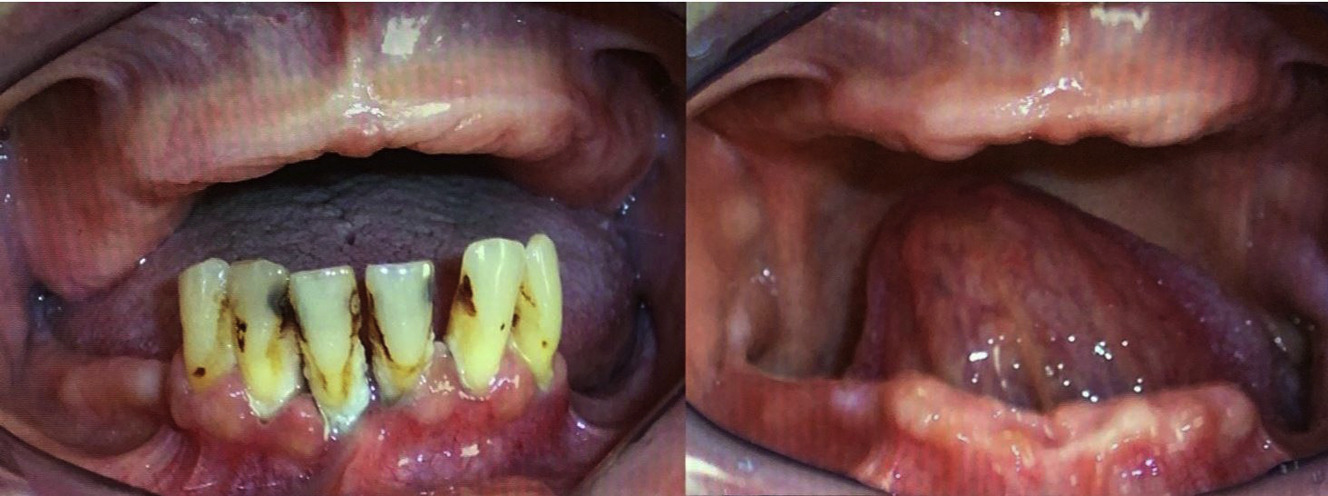 Alveoloplasty in conjunction with extractions- Before and after