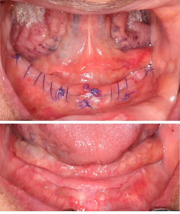 Alveoloplasty - shaping the alveolar ridge for denture