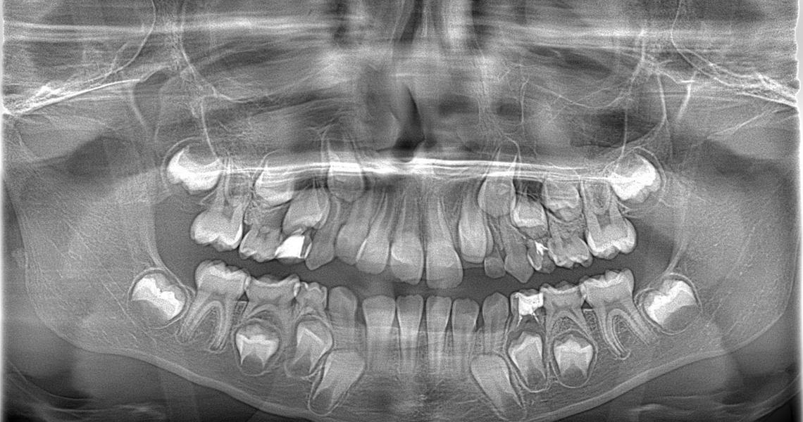 Toddler teeth xray. OPG Xray Of Child Teeth showing milk teeth and growing permanent teeth