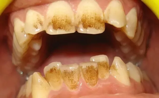 Black Stains on Teeth: Causes, Prevention, and How to Remove Them Naturally