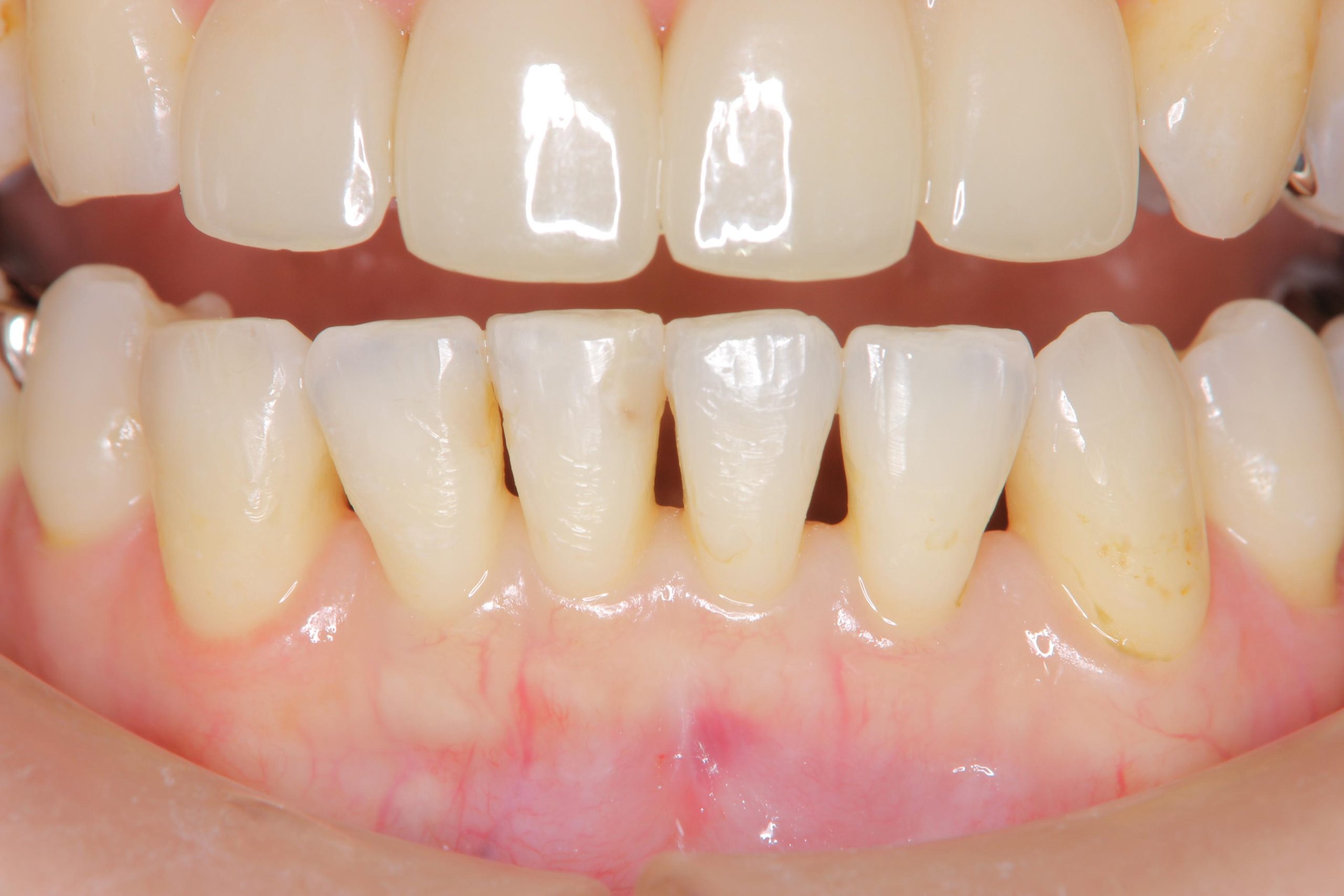 How to Fix Black Triangle Teeth: Causes, Treatment Options, and Prevention Tips