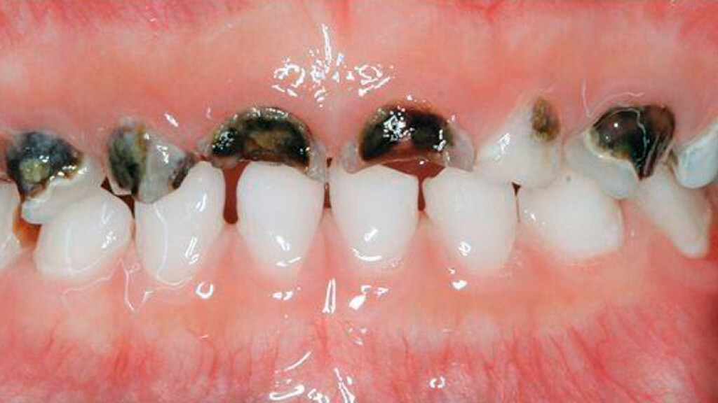 Black stains on baby teeth-Black stains on front of teeth due to Teeth decay