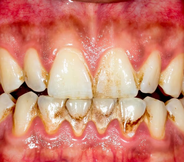 Black stains on teeth due to tartar deposit.