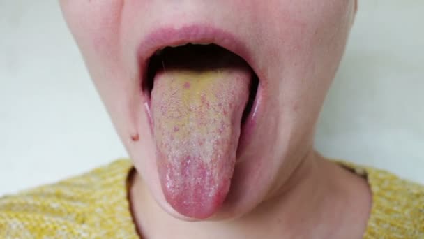 brown stuff on tongue. Brown on tongue Poor Oral Hygiene