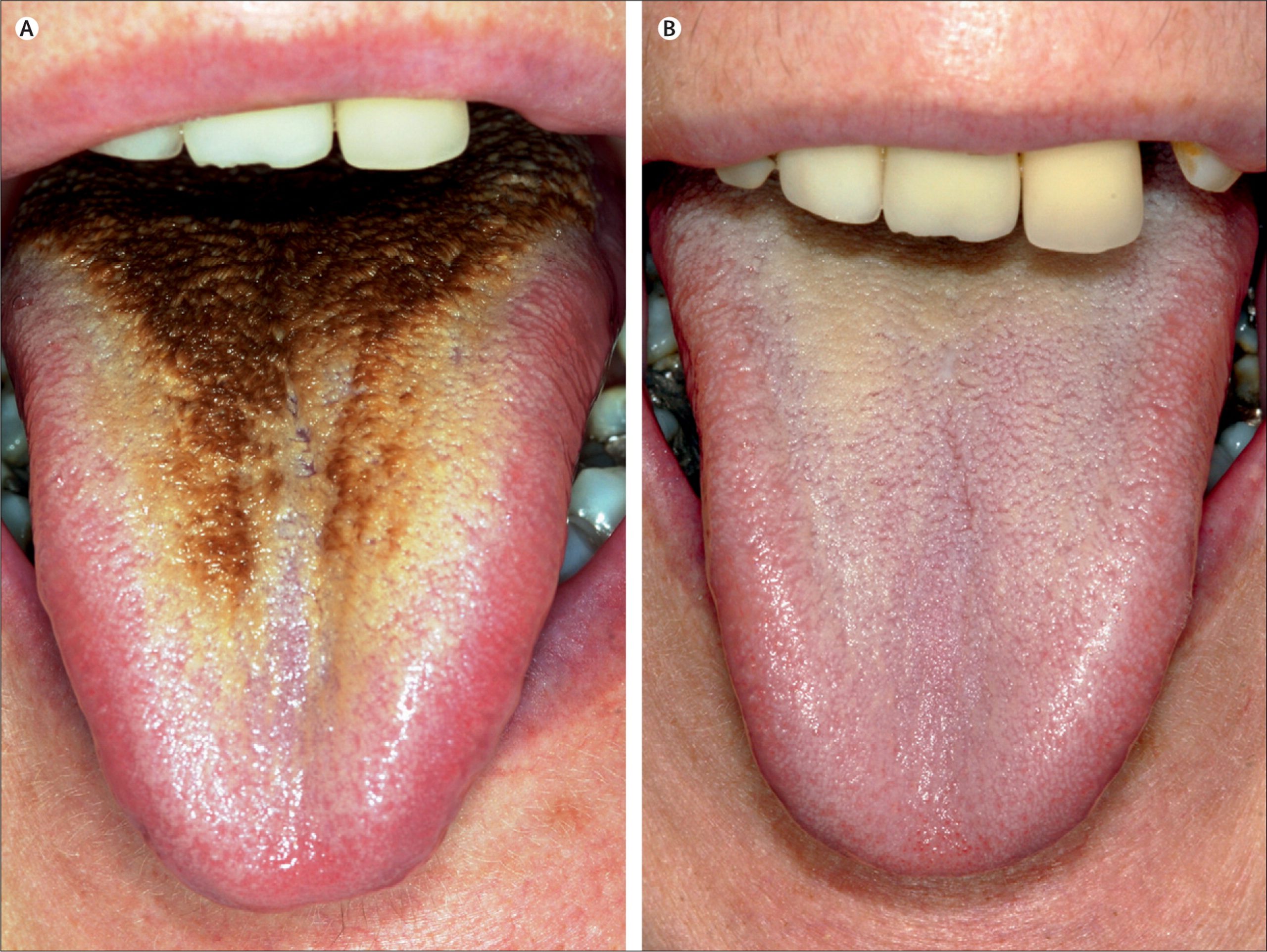 Brown stuff on tongue-Black Hairy Tongue (Lingua Villosa)