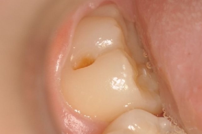 Buccal pit cavity-Buccal filling on side of tooth