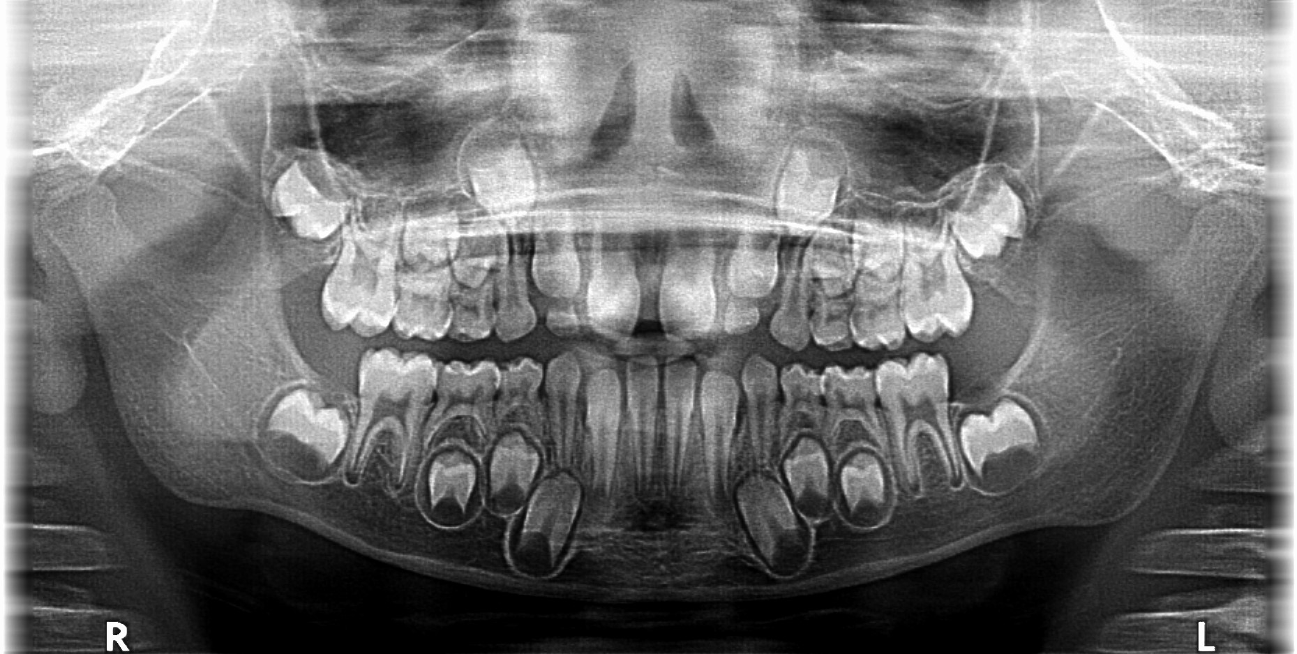 x-ray of baby teeth and permanent teeth, 