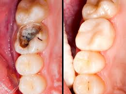 Dental filling for cavity in tooth to protect its health