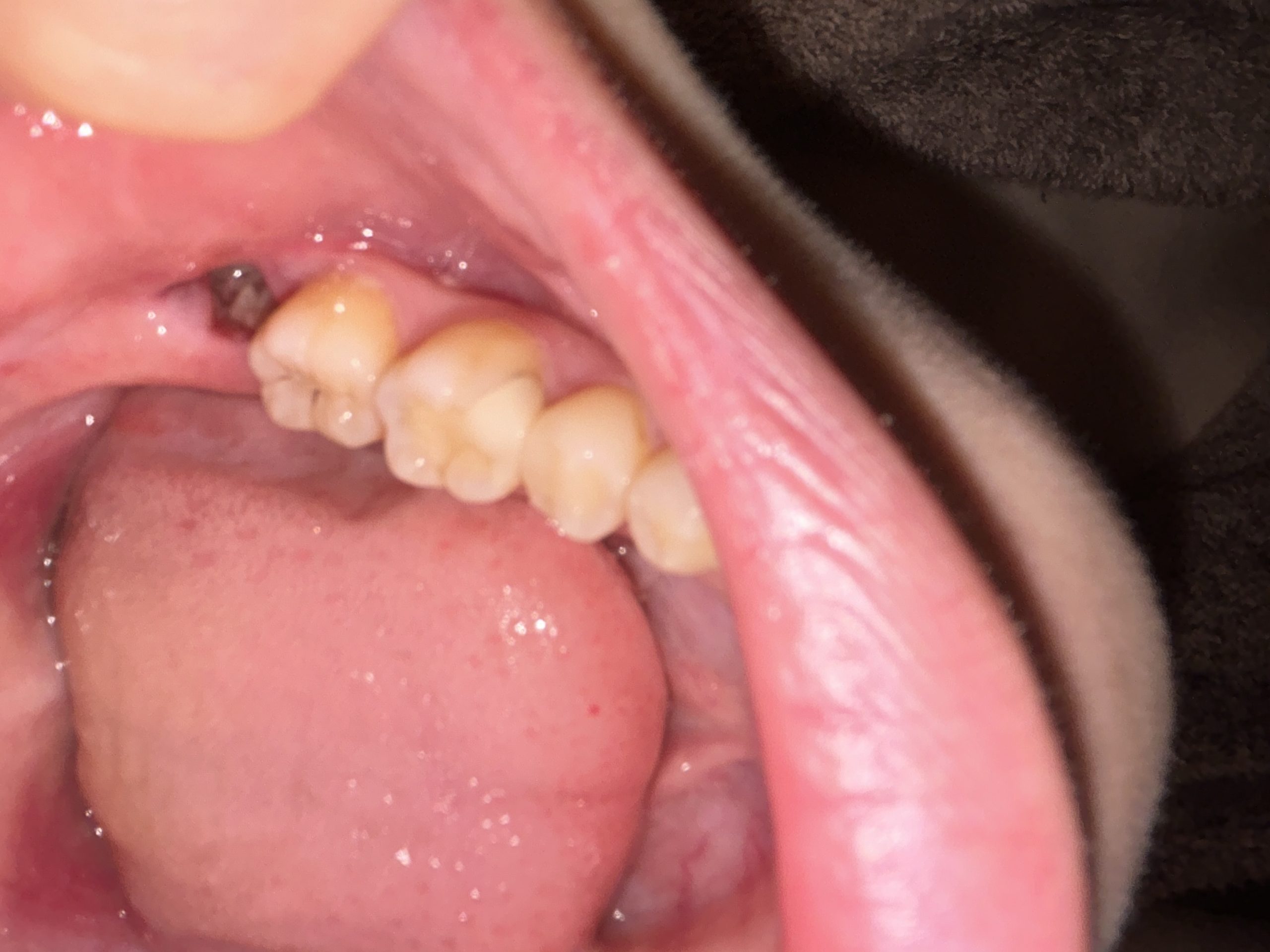 Dry Socket after Wisdom Tooth Removal