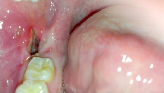 Dry Socket after wisdom tooth removal with swelling and pain. when does swelling go down after wisdom teeth removal.