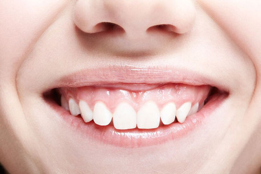 Effective Treatments for a Gummy Smile: How to Achieve a Balanced, Confident Smile