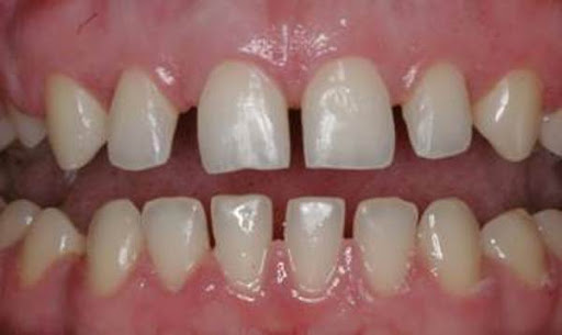 Generalized microdontia causing small adult teeth