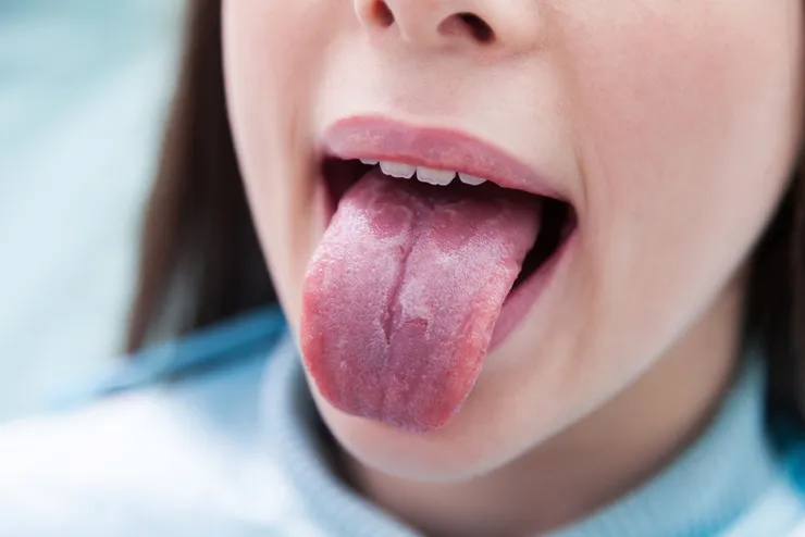 Geographic tongue with brown stuff on tongue