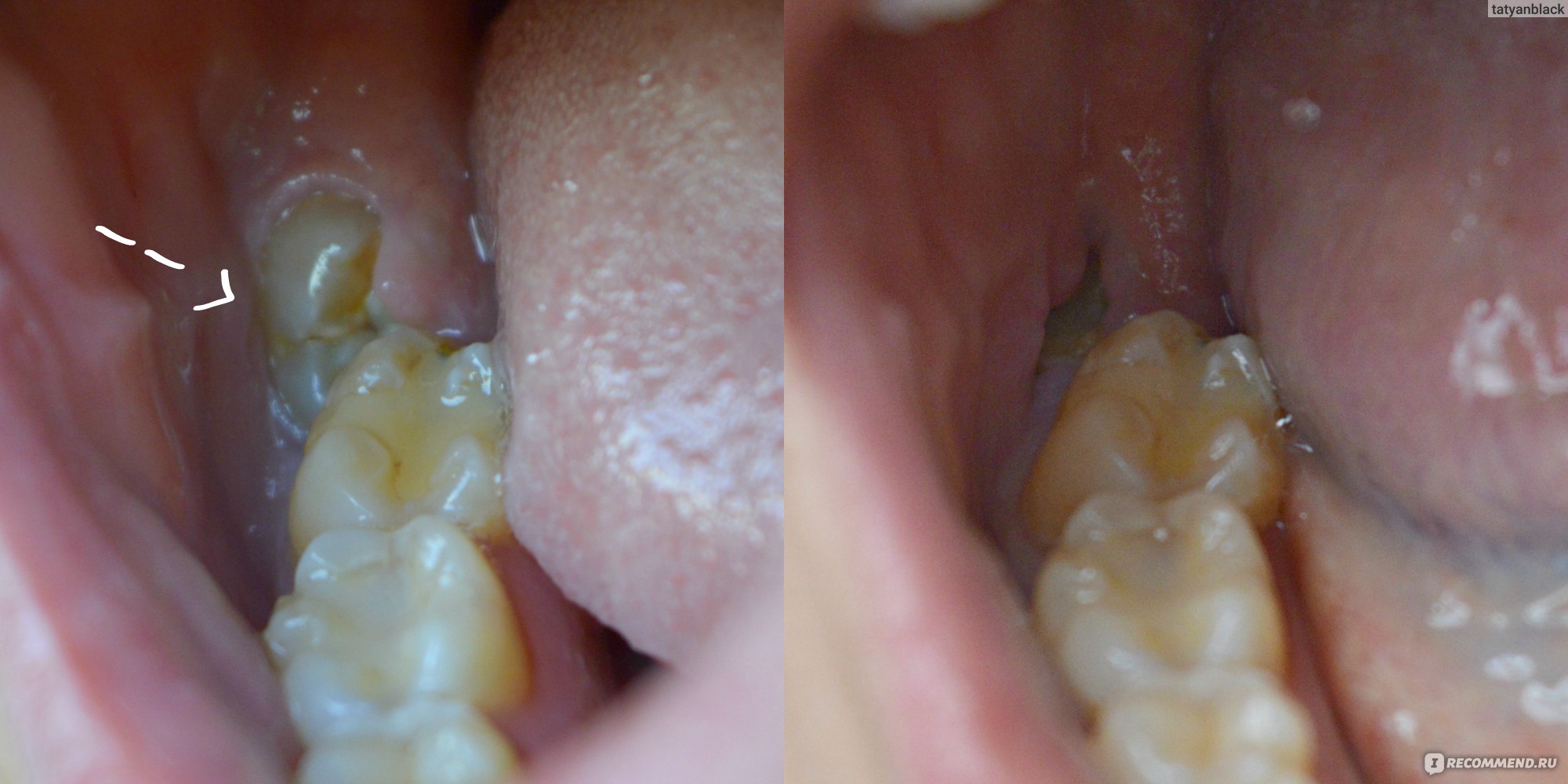 Growing Wisdom Tooth Having Pain Removed.