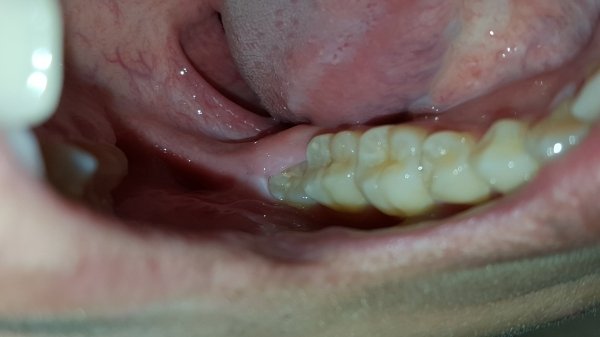 growing wisdom tooth put pressure in surrounding gums causing pain