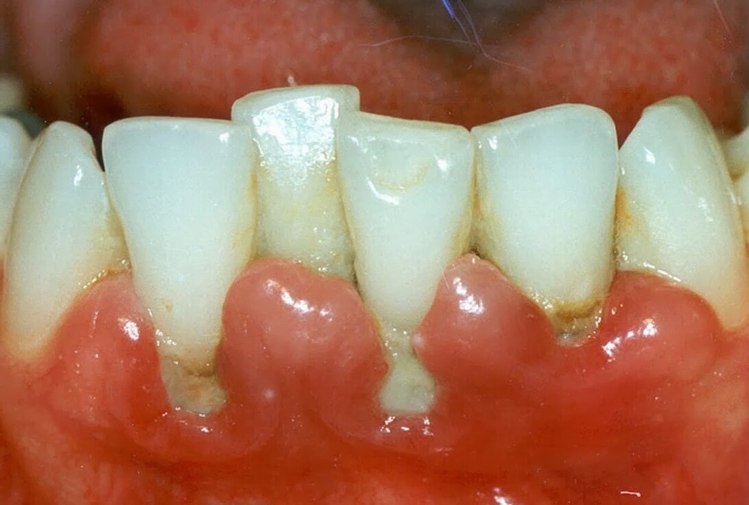 Gums disease may be the answer to why do all of my teeth hurt