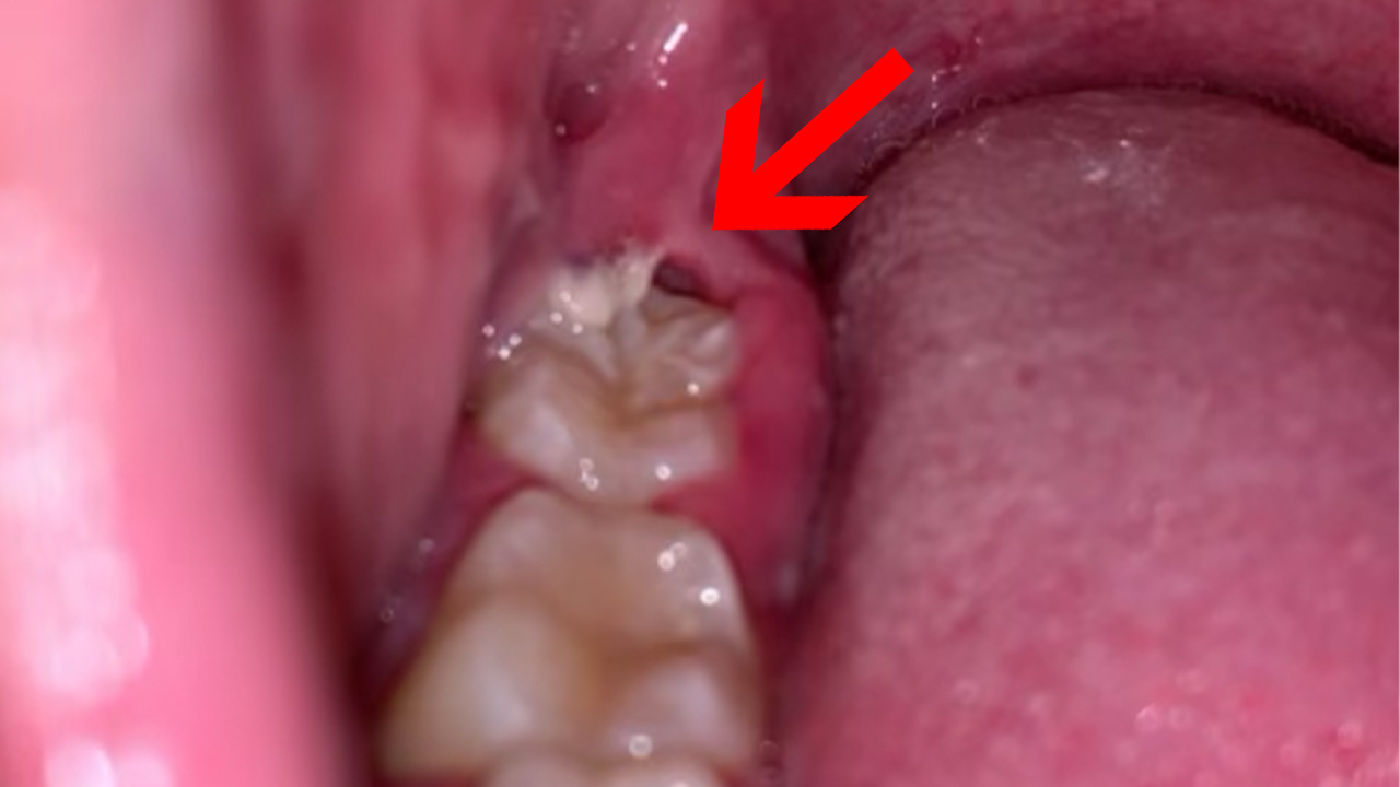 Gums over growing wisdom tooth get infected with food deposition and trauma from upper teeth during eating causing pain in area .how to relieve growing wisdom tooth pain